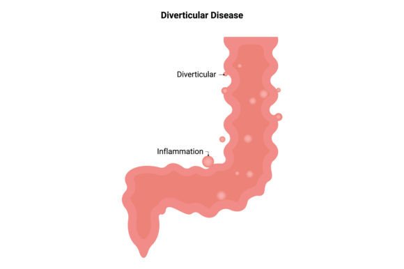 Download Diverticular Disease Science Design - Disease Collection