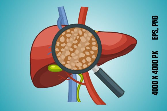 Download Liver Disease - Disease Collection