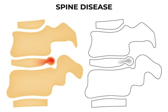 Download Spine Disease Science Design Vector - Disease Collection