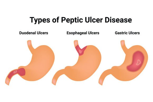 Download Type of Peptic Ulcer Disease Science Des - Disease Collection