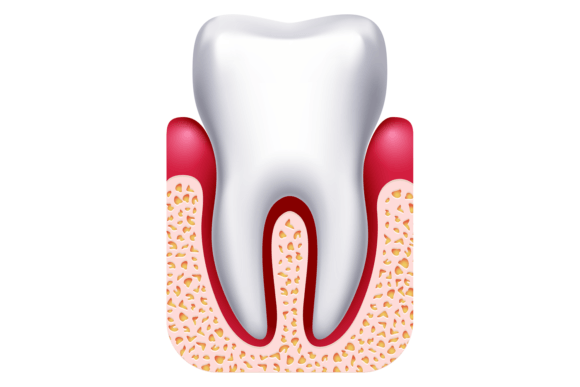Download Gingivitis Illustration. Gum Disease. De - Disease Collection